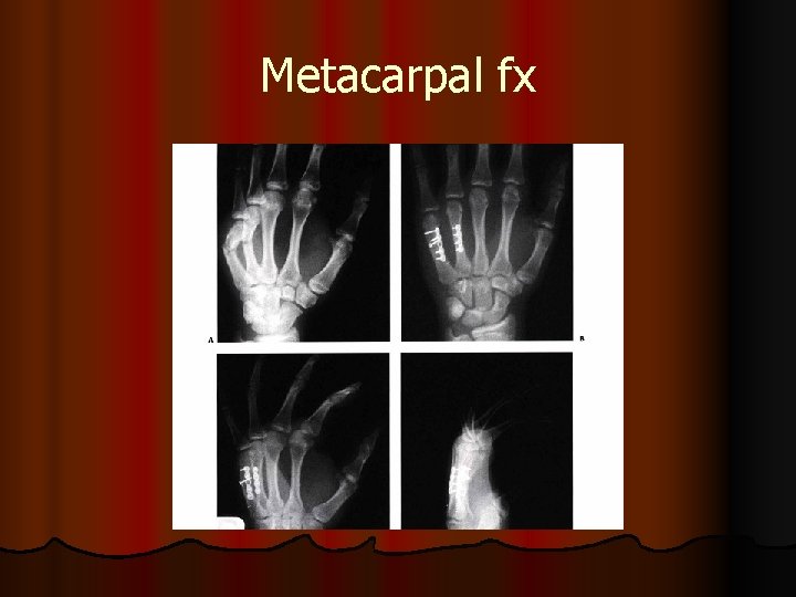 Metacarpal fx 