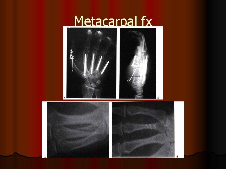 Metacarpal fx 