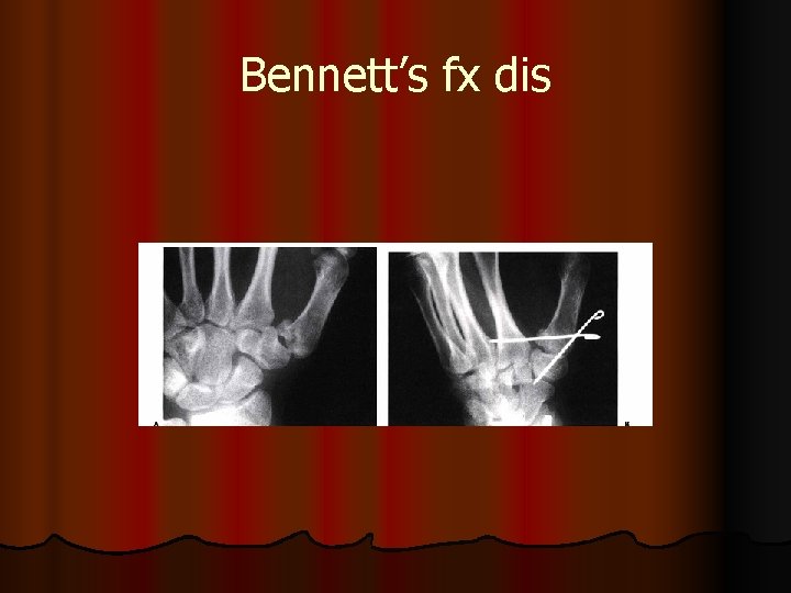 Bennett’s fx dis 