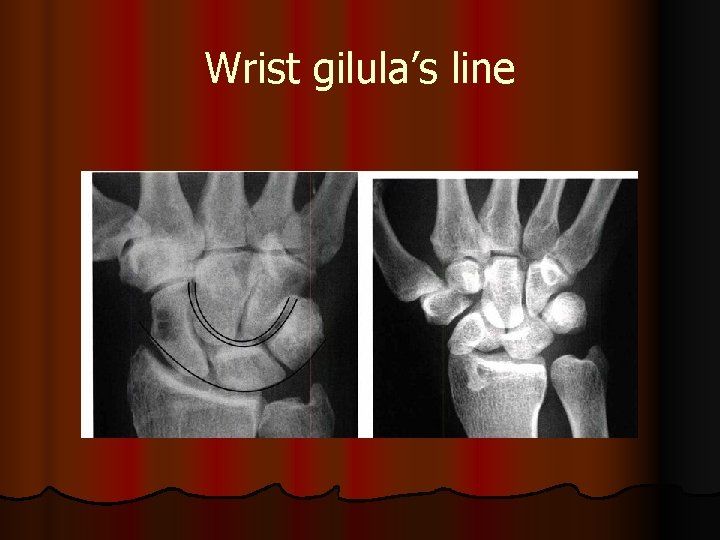 Wrist gilula’s line 