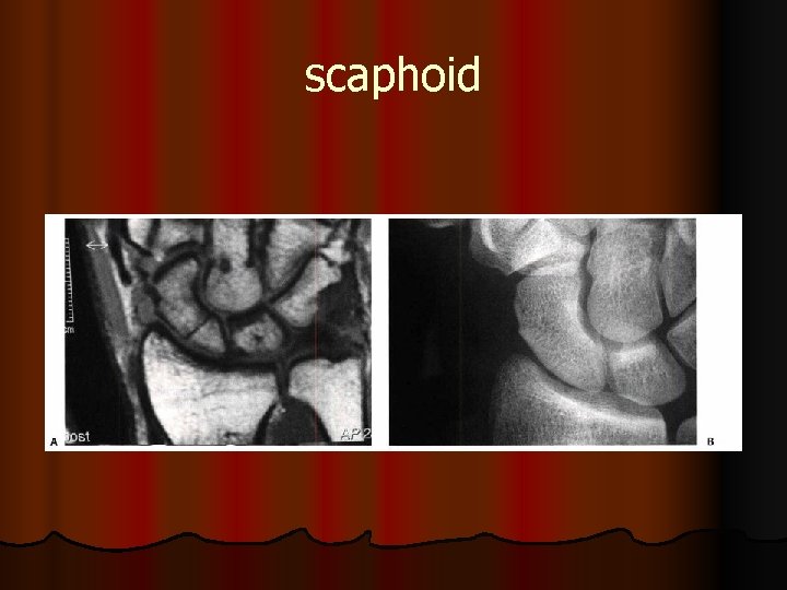 scaphoid 