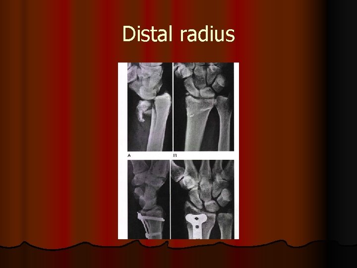 Distal radius 