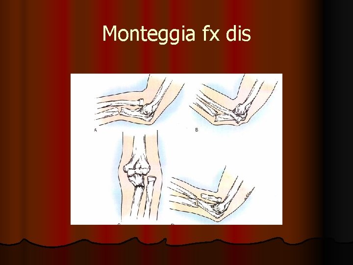 Monteggia fx dis 