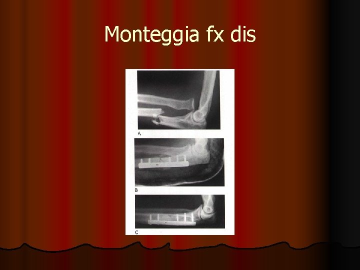 Monteggia fx dis 