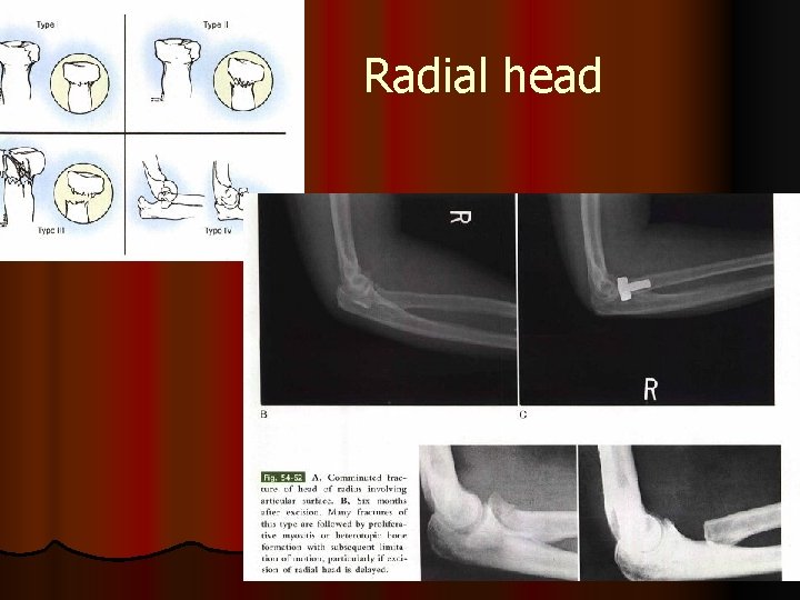 Radial head 