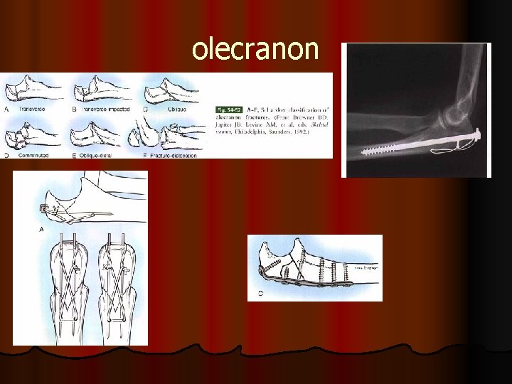 olecranon 