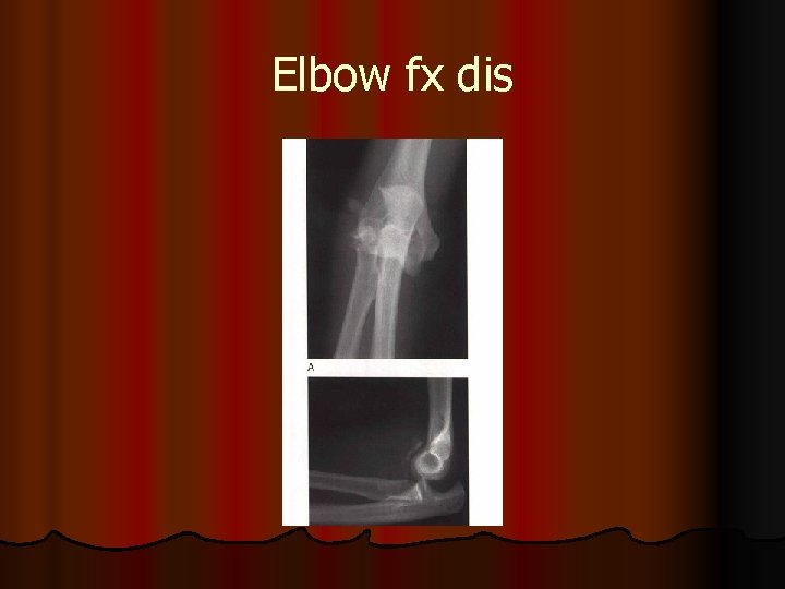 Elbow fx dis 