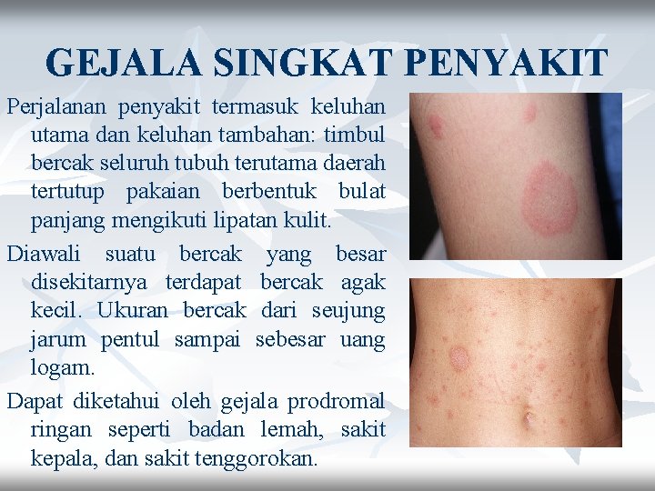 GEJALA SINGKAT PENYAKIT Perjalanan penyakit termasuk keluhan utama dan keluhan tambahan: timbul bercak seluruh