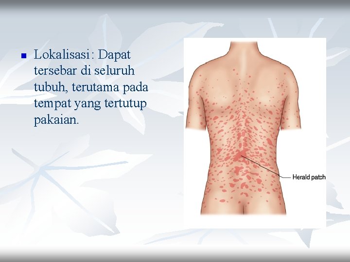 n Lokalisasi : Dapat tersebar di seluruh tubuh, terutama pada tempat yang tertutup pakaian.