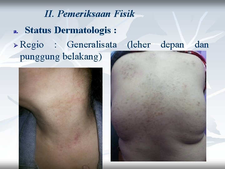 II. Pemeriksaan Fisik Status Dermatologis : Ø Regio : Generalisata (leher depan dan punggung