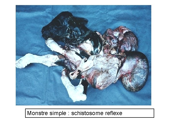 Monstre simple : schistosome reflexe 