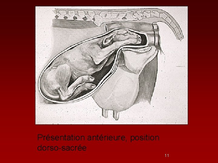 Présentation antérieure, position dorso-sacrée 11 