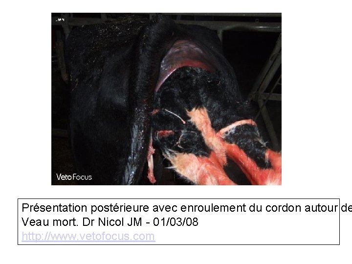Présentation postérieure avec enroulement du cordon autour de Veau mort. Dr Nicol JM -