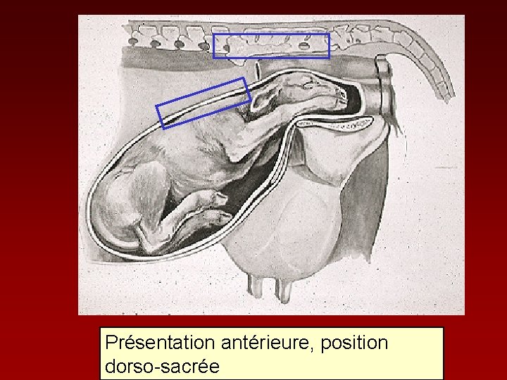 Présentation antérieure, position 14 dorso-sacrée 