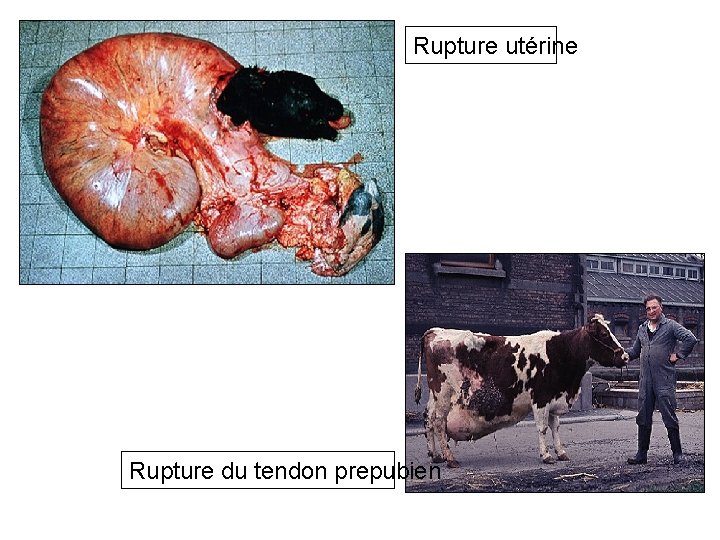 Rupture utérine Rupture du tendon prepubien 
