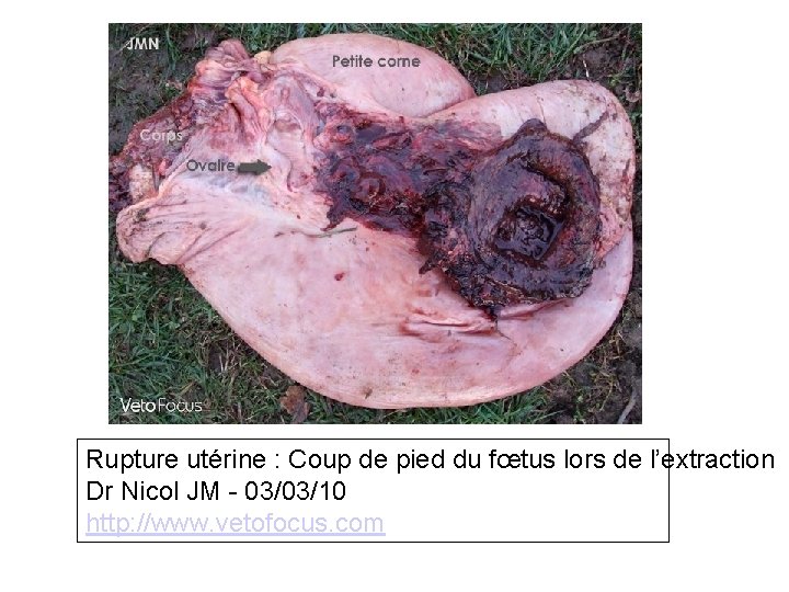 Rupture utérine : Coup de pied du fœtus lors de l’extraction Dr Nicol JM