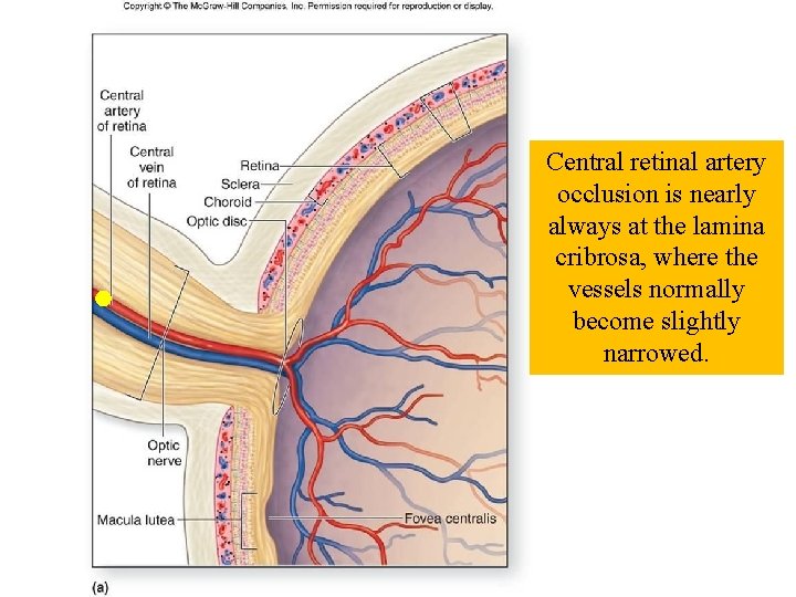 Central retinal artery occlusion is nearly always at the lamina cribrosa, where the vessels Central retinal artery occlusion is nearly always at the lamina cribrosa, where the vessels