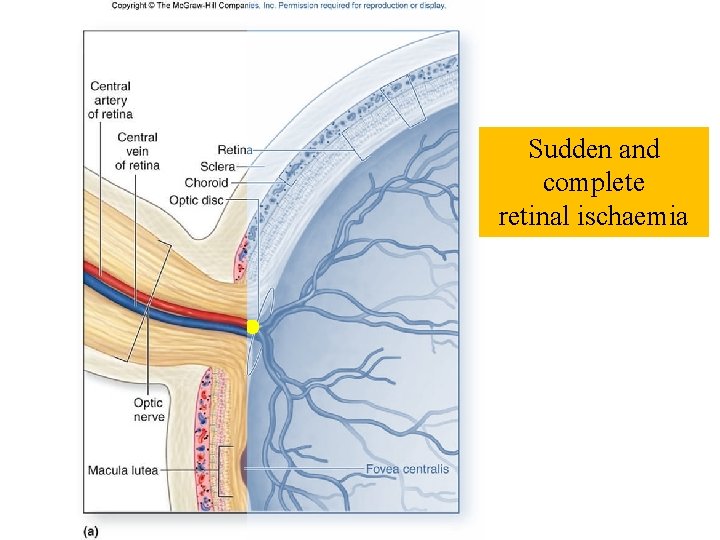 Sudden and complete retinal ischaemia Sudden and complete retinal ischaemia