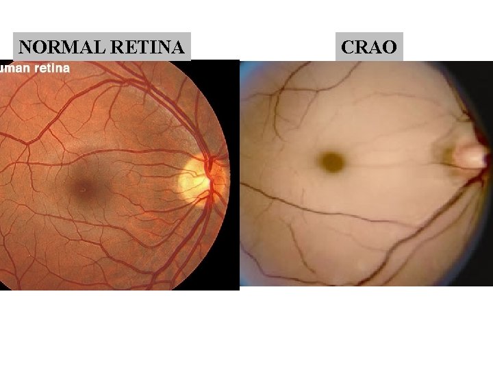 NORMAL RETINA CRAO NORMAL RETINA CRAO