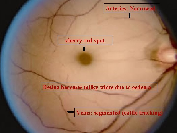 Arteries: Narrowed cherry-red spot Retina becomes milky white due to oedema Veins: segmented (cattle Arteries: Narrowed cherry-red spot Retina becomes milky white due to oedema Veins: segmented (cattle