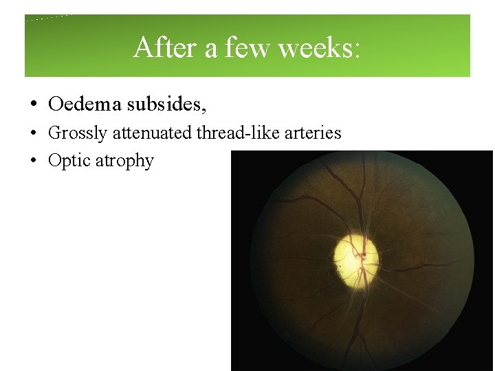 After a few weeks: • Oedema subsides, • Grossly attenuated thread-like arteries • Optic After a few weeks: • Oedema subsides, • Grossly attenuated thread-like arteries • Optic