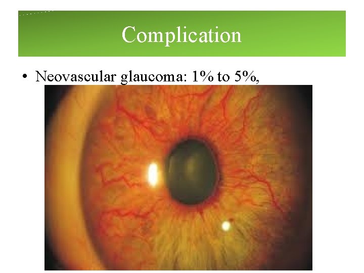 Complication • Neovascular glaucoma: 1% to 5%, Complication • Neovascular glaucoma: 1% to 5%,