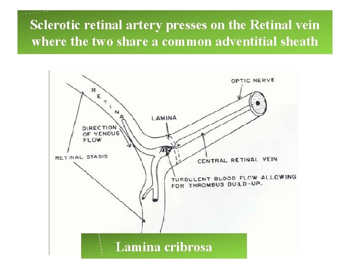 Sclerotic retinal artery presses on the Retinal vein where the two share a common Sclerotic retinal artery presses on the Retinal vein where the two share a common