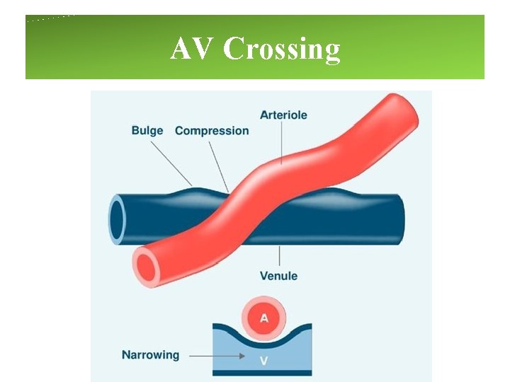 AV Crossing AV Crossing