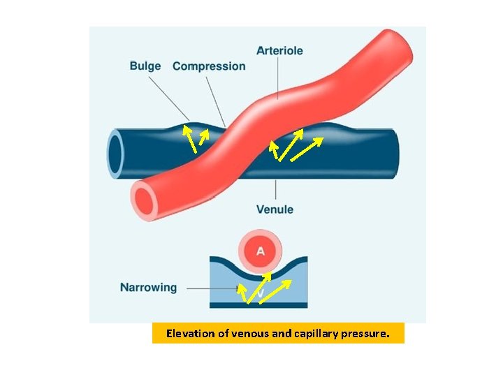 Elevation of venous and capillary pressure. Elevation of venous and capillary pressure.
