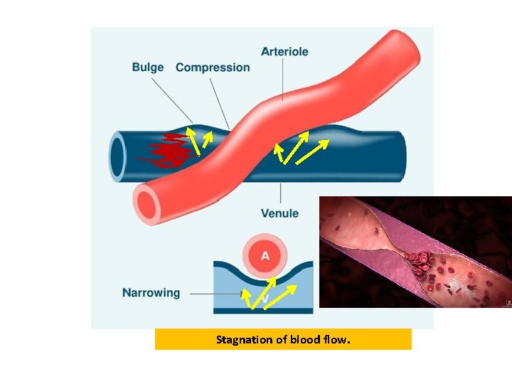 Stagnation of blood flow. Stagnation of blood flow.