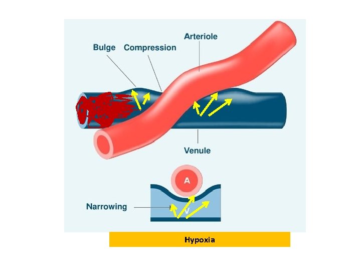 Hypoxia Hypoxia