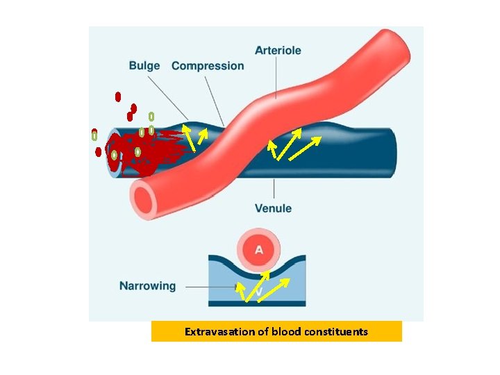 Extravasation of blood constituents Extravasation of blood constituents