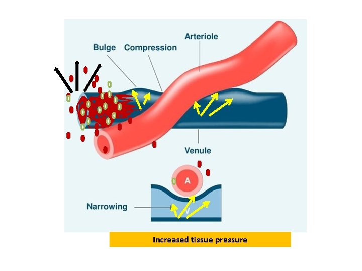 Increased tissue pressure Increased tissue pressure