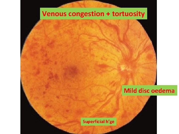 Venous congestion + tortuosity Mild disc oedema Superficial h’ge Venous congestion + tortuosity Mild disc oedema Superficial h’ge