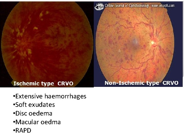 • Extensive haemorrhages • Soft exudates • Disc oedema • Macular oedma • • Extensive haemorrhages • Soft exudates • Disc oedema • Macular oedma •