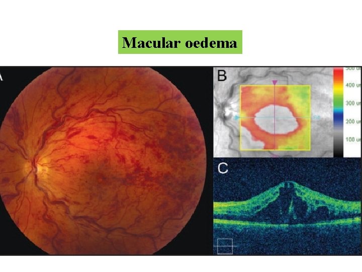 Macular oedema Macular oedema