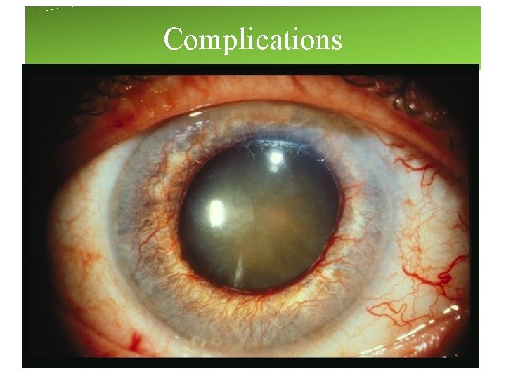 Complications Complications