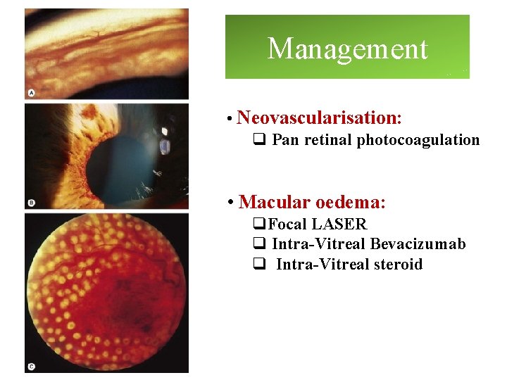 Management • Neovascularisation: q Pan retinal photocoagulation • Macular oedema: q. Focal LASER q Management • Neovascularisation: q Pan retinal photocoagulation • Macular oedema: q. Focal LASER q