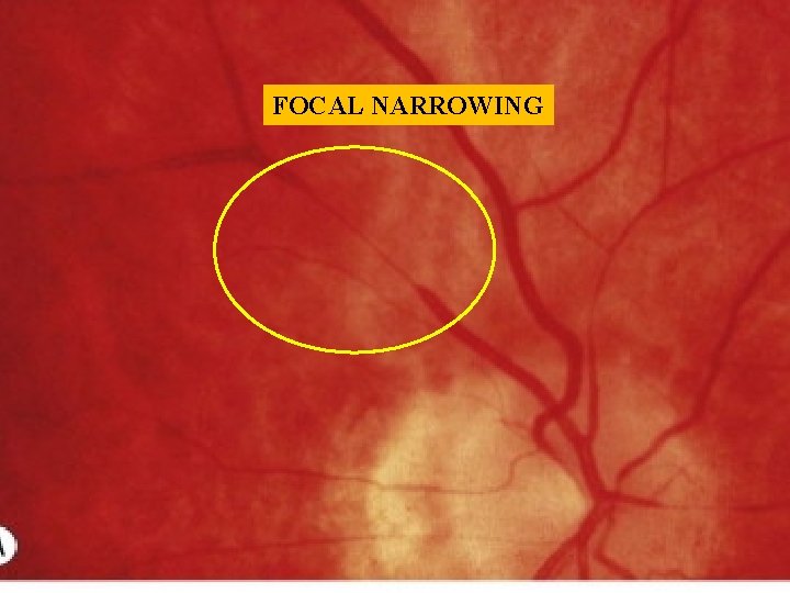 FOCAL NARROWING FOCAL NARROWING