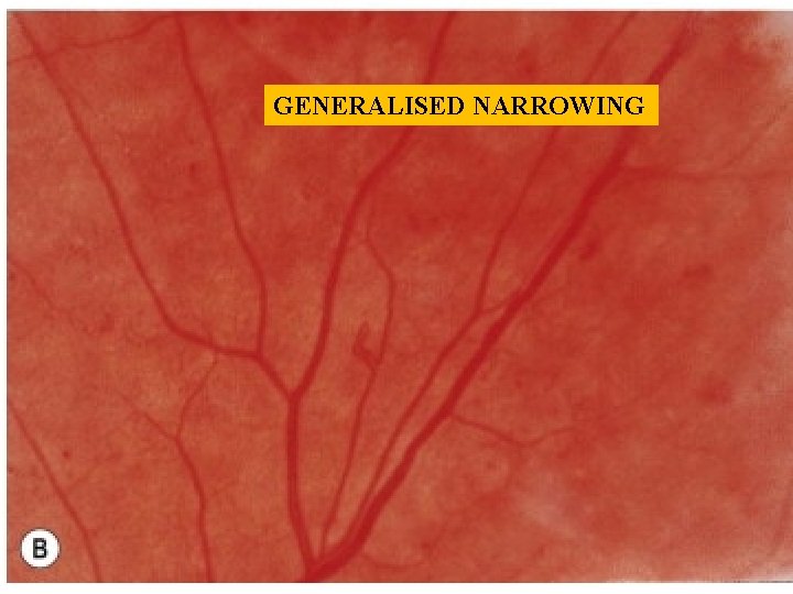 GENERALISED NARROWING GENERALISED NARROWING