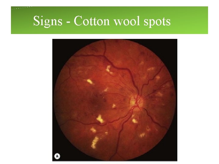 Signs - Cotton wool spots Signs - Cotton wool spots