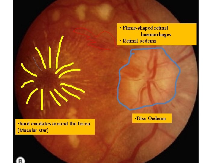 • Flame-shaped retinal haemorrhages • Retinal oedema • hard exudates around the fovea • Flame-shaped retinal haemorrhages • Retinal oedema • hard exudates around the fovea
