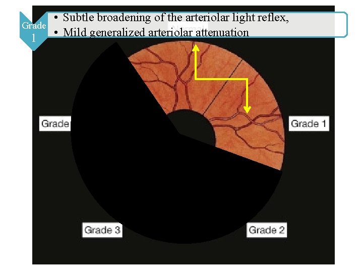 • Subtle broadening of the arteriolar light reflex, Grade 1 • Mild generalized • Subtle broadening of the arteriolar light reflex, Grade 1 • Mild generalized