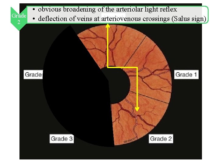 • obvious broadening of the arteriolar light reflex Grade • deflection of veins • obvious broadening of the arteriolar light reflex Grade • deflection of veins