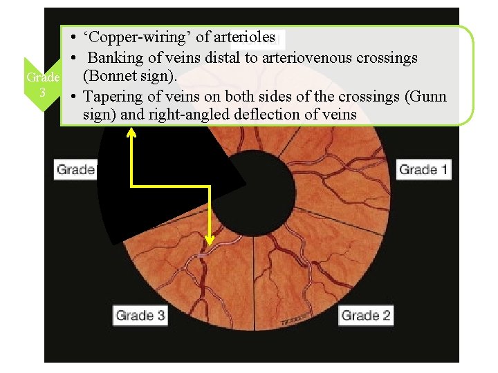 • ‘Copper-wiring’ of arterioles • Banking of veins distal to arteriovenous crossings (Bonnet • ‘Copper-wiring’ of arterioles • Banking of veins distal to arteriovenous crossings (Bonnet