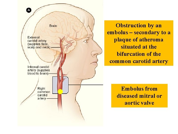 Obstruction by an embolus – secondary to a plaque of atheroma situated at the Obstruction by an embolus – secondary to a plaque of atheroma situated at the