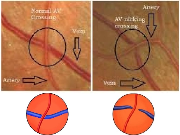 Normal Vs Arteriosclerosis Normal Vs Arteriosclerosis