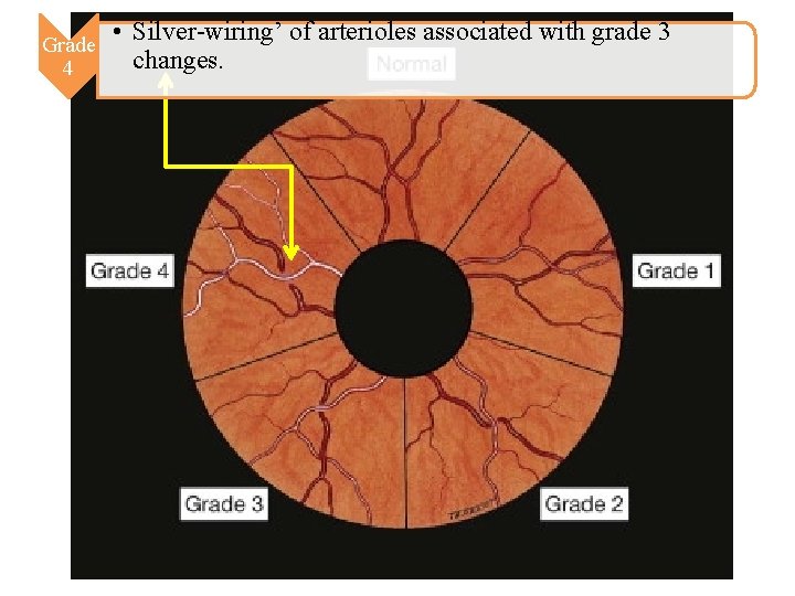 Grade 4 • Silver-wiring’ of arterioles associated with grade 3 changes. Grade 4 • Silver-wiring’ of arterioles associated with grade 3 changes.