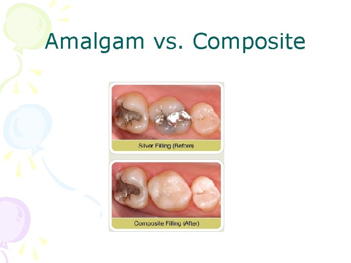 Amalgam vs. Composite 
