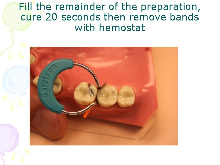 Fill the remainder of the preparation, cure 20 seconds then remove bands with hemostat